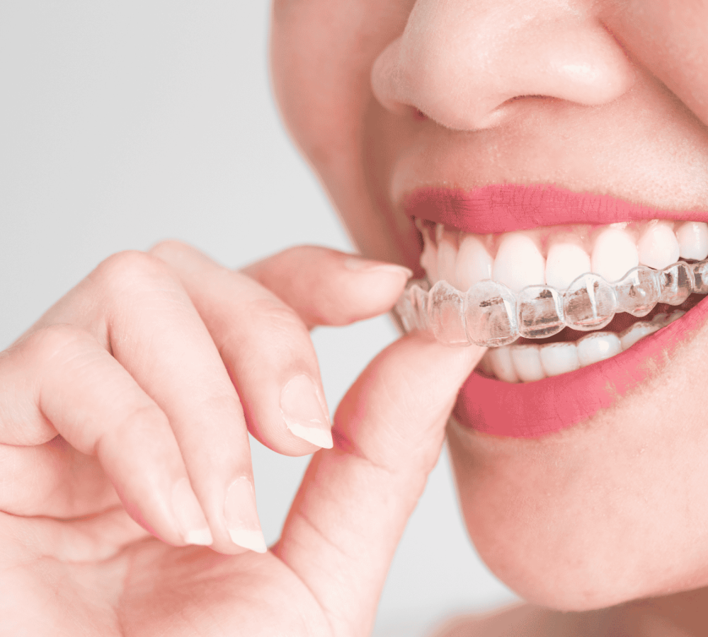 gouttiere invisible orthodontie